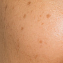 Dark Spots